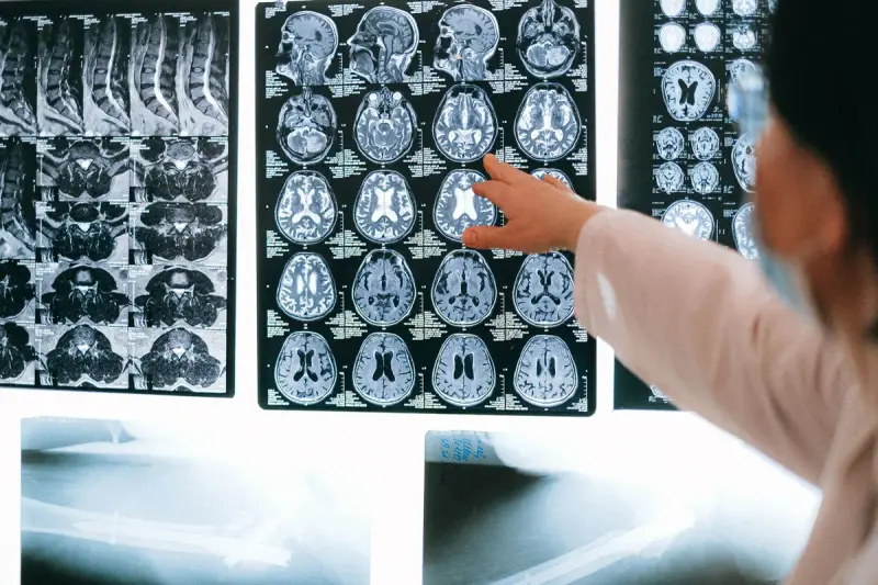 Clinician pointing at rows of brain MRI slices on an illuminated viewing wall