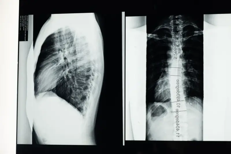 Side and back spine X-rays on a lightbox with curvature angle measurements marked