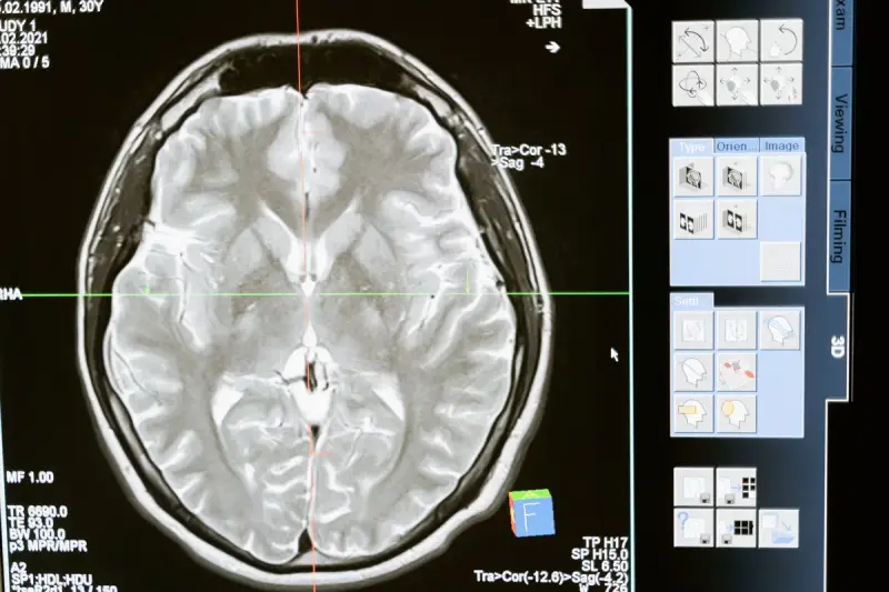 MRI scan of a human brain in cross-section displayed on a computer screen